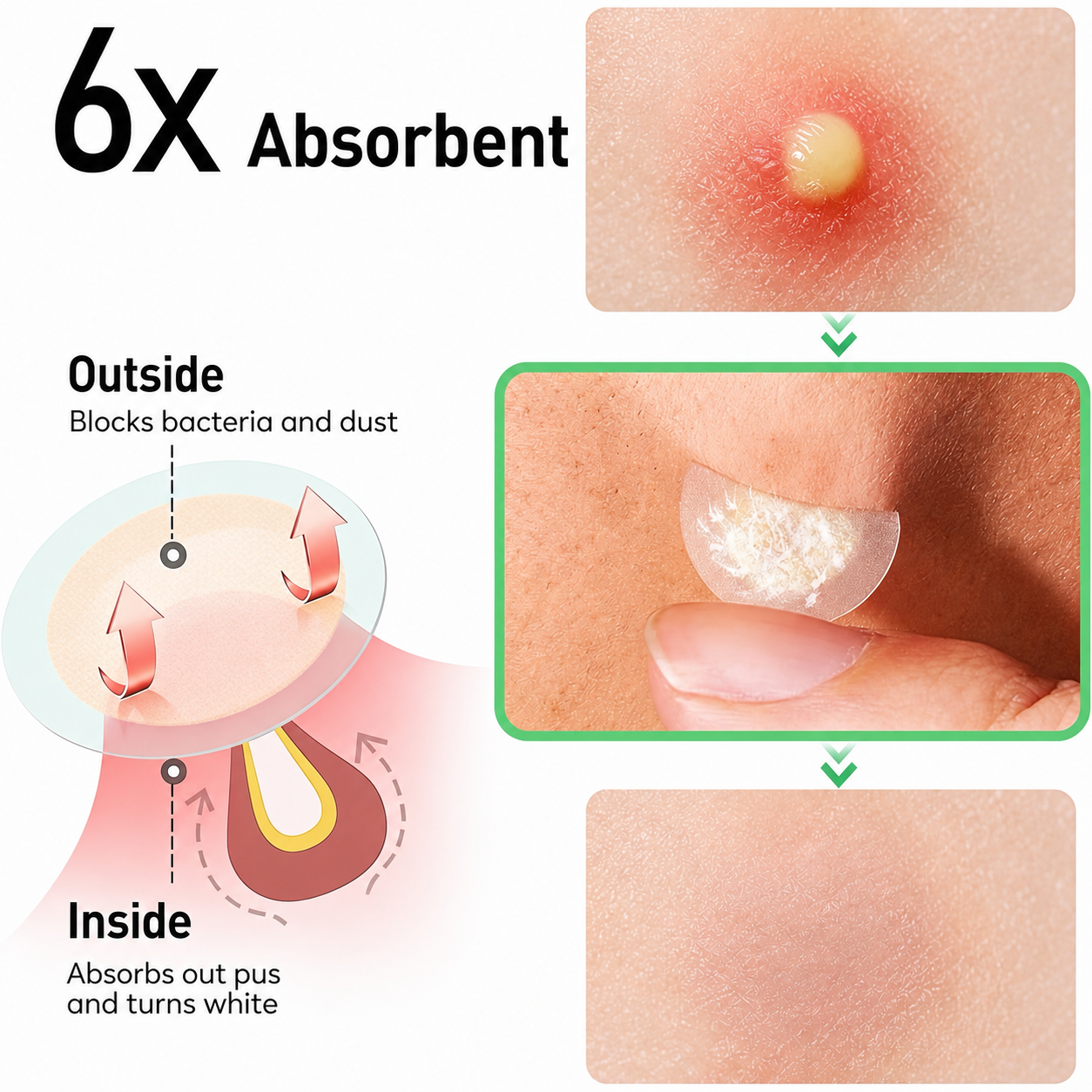 443PCS HITWORKER Hydrocolloid Patches - 5 Sizes - Anglo Cosmetics